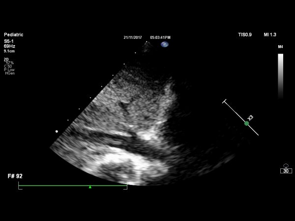 Fontan palliation for single ventricle – SujyotHeartClinic