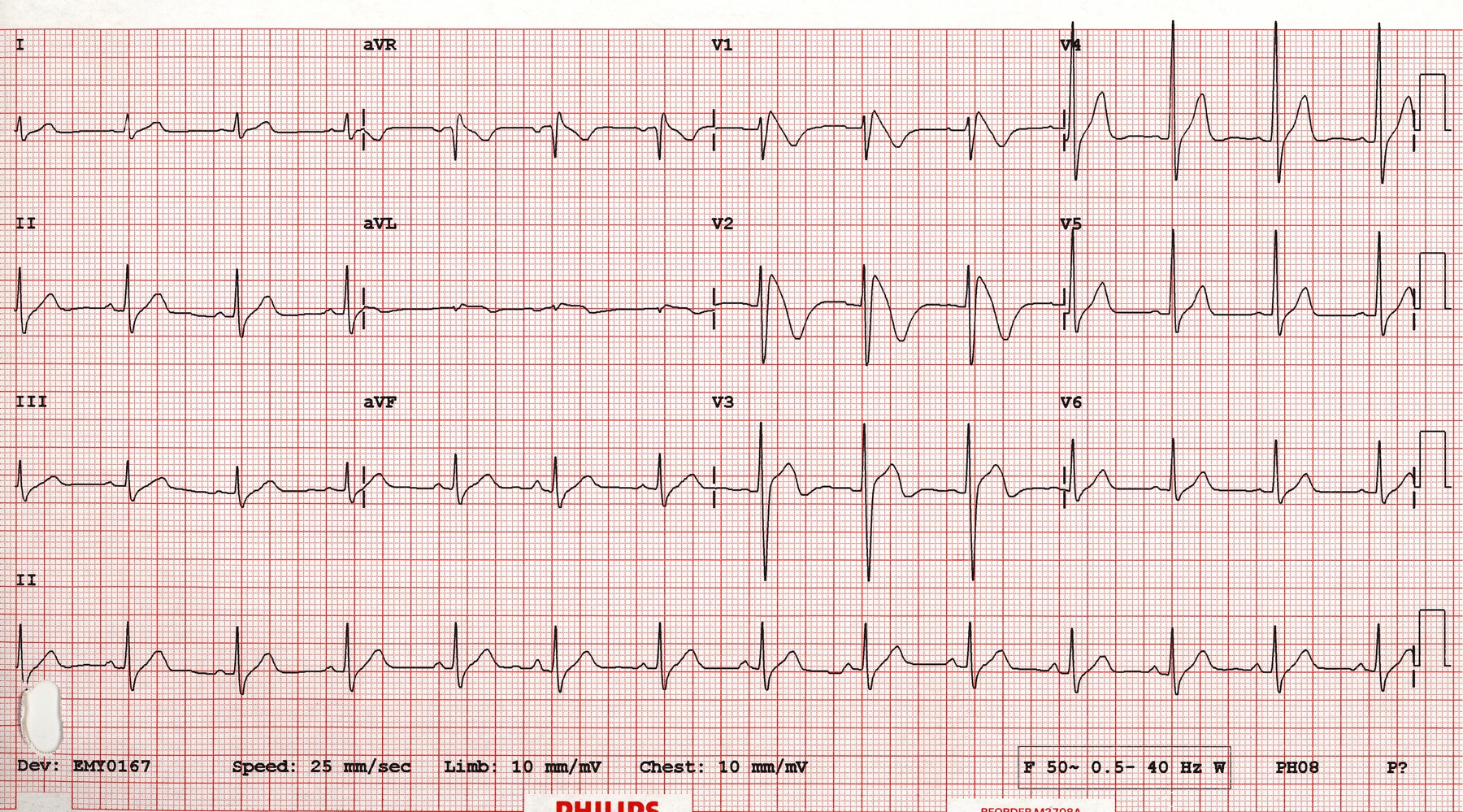 12 Lead ECG For Children And Adults SujyotHeartClinic