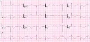 Adult 2D echo with GLS – SujyotHeartClinic