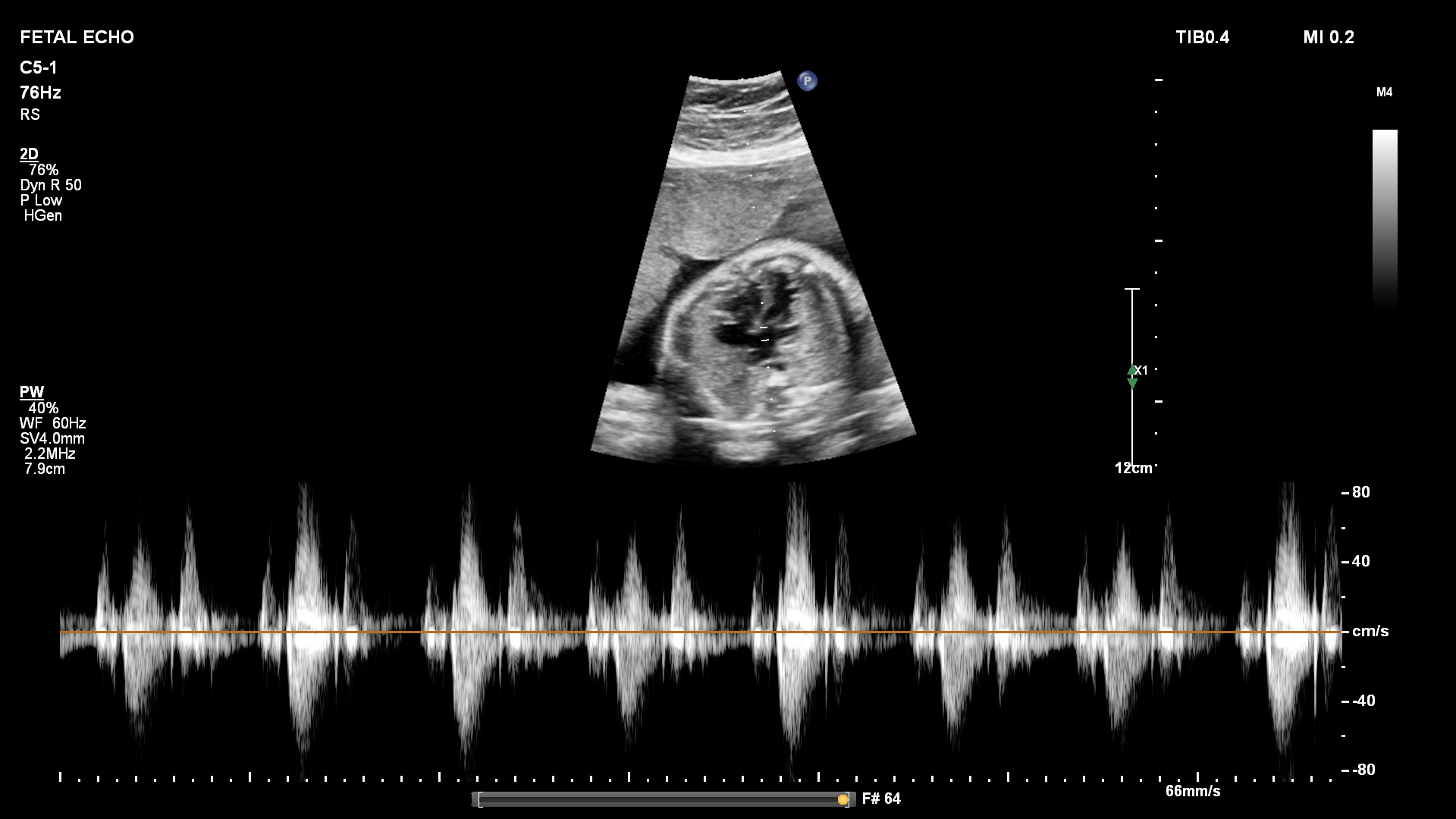 Fetal 2d Echocardiography And Colour Doppler Sujyotheartclinic