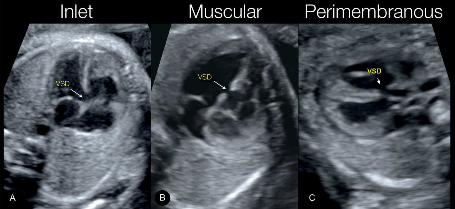 Fetal Echo Types Of Ventricular Septal Defects Sujyotheartclinic