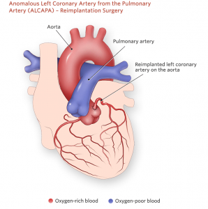 ALCAPA-Reimplmentation Surgery – SujyotHeartClinic