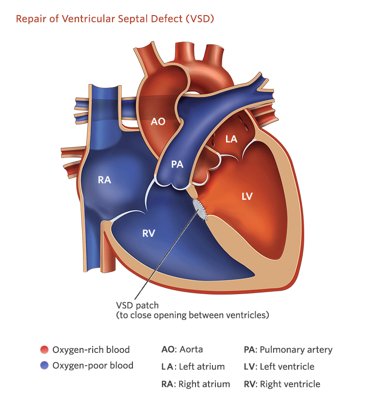 Ventricular Septal Defect (VSD) SujyotHeartClinic