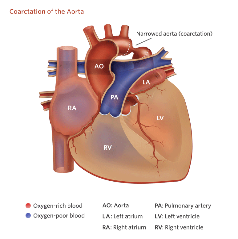 how does aortic coarctation cause radiofemoral delay