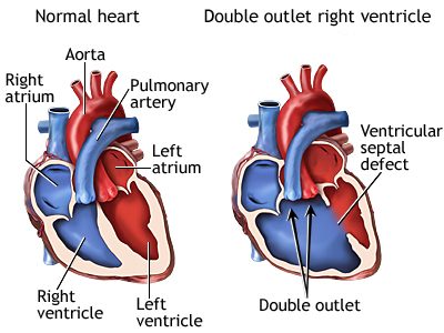 Double Outlet Right Ventricle – SujyotHeartClinic