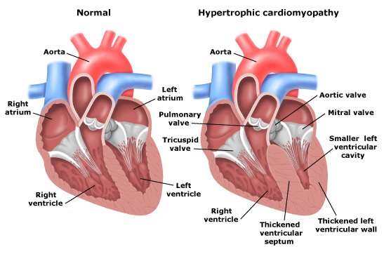 Cardiomyopathy clearance