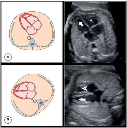 Normal ventricular variants. a Moderator band (arrow) and an