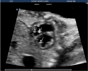echogenic foci lv rv multiple heart focus fetal